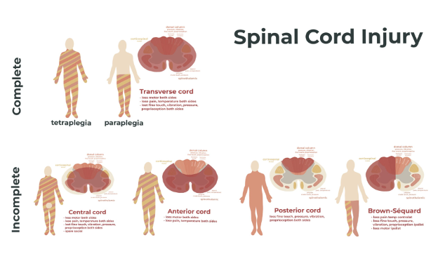 Spinal cord injury explained.
